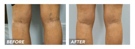 Nationally Recognized Vein Doctor Vein Treatment A Cost Effective