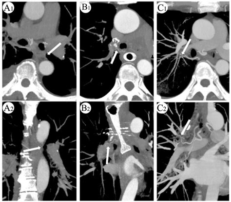 Triple Low Radiation Dose Bronchial Artery Ct Angiography Before