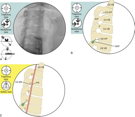 Cervical Transforaminal Epidural Steroid Injection | Musculoskeletal Key