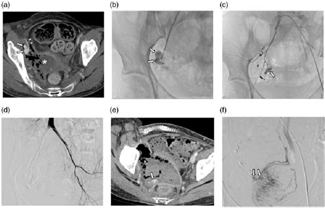 Figure 1 From Endovascular Treatment For The Control Of Active Vaginal