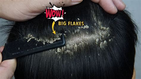 Dandruff Combing Big Flakes Satisfying 1148 YouTube