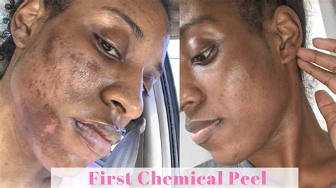 First Tca Chemical Peel Vlogmas Day Youtube