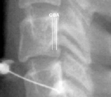 Lateral Cervical Spine Fluoroscopic Spot Image Demonstrating Various