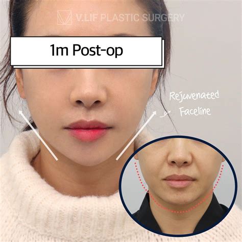 facelift korea plastic surgery facial lift korea saggy skin droopy skin ...