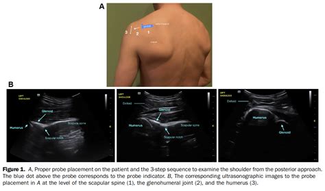 MSK Ultrasound For Shoulder Dislocation JournalFeed