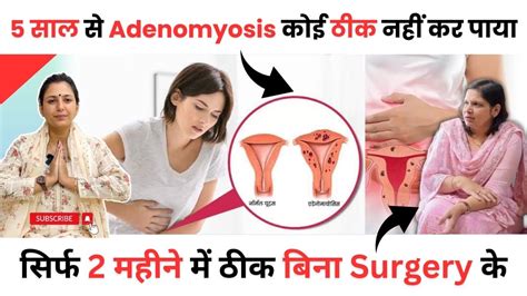 Adenomyosis Symptoms And Treatments Hindi Adenomyosis Treatment Without