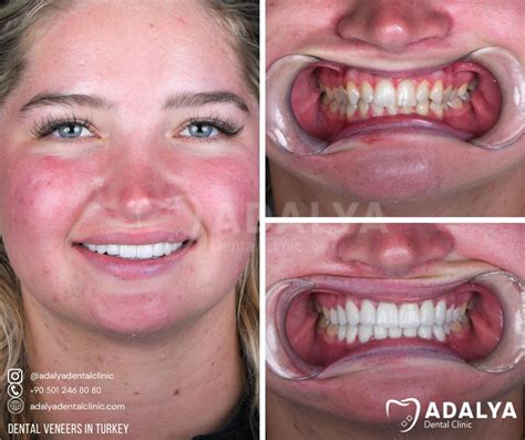 Turkey Teeth Veneers Before And After Adalya Dental Clinic