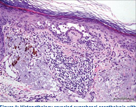 Cutaneous Toxicity Of A New Braf Inhibitor Lgx Encorafenib