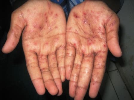 Ciri Ciri Penyakit Scabies Homecare24