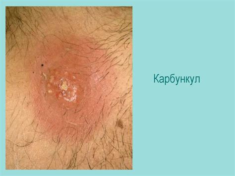 Пиодермии. Классификация пиодермий - презентация онлайн