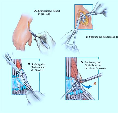 Tendovaginitis Stenosans De Quervain Thyreoiditis Krankheit Entz Ndung