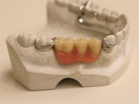 Dentures: Guide to False Teeth Types, Costs and More - Dentaly.org