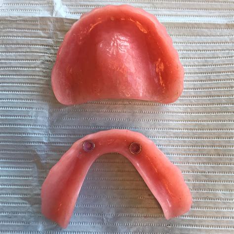 Upper Complete Denture And Lower Implant Overdenture The True Life Of