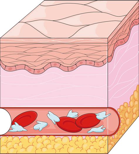 Coagulation - Servier Medical Art