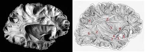 Superior longitudinal fasciculus - Wikipedia