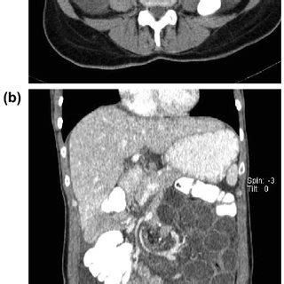 A Axial B Coronal Reformatted Image Of The Abdomen Showing Swirl