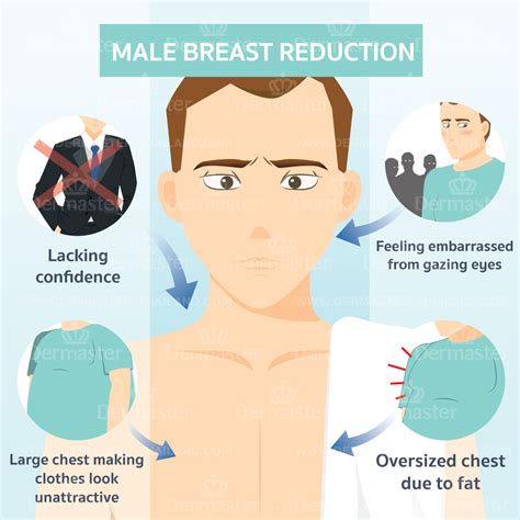 Male Breast Reduction Natural And Self Confident Dermaster