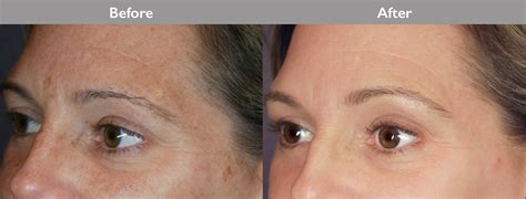 IPL Photo Facial — Dr. Kenneth Mark