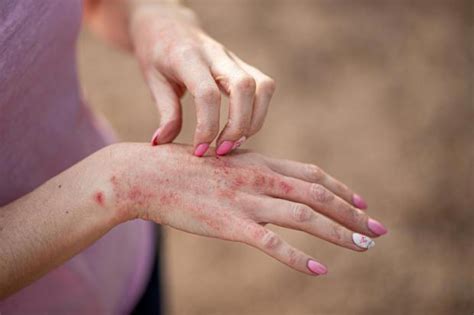 What Is Contact Dermatitis Symptoms And When To See A Doctor