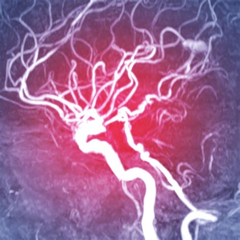 Aneurysm Clipping | Microsurgical Clipping | NSPC