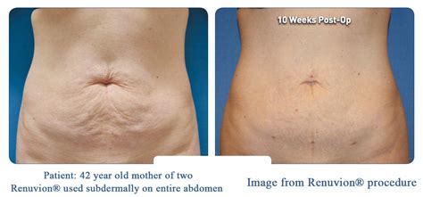 Lipo And Renuvion Vs Tummy Tuck Omaha Liposuction By Imagen