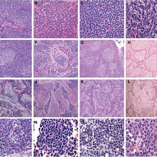 Histologic Variants Outside Of Those In The Medulloblastoma Include