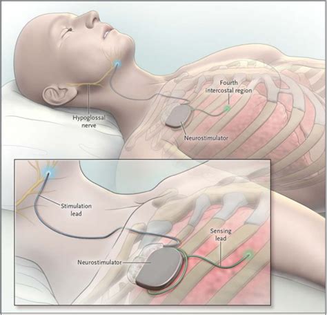 Potential to improve CPAP compliance, FDA approves first implantable sleep apnea device