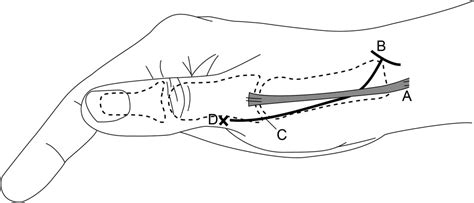 Reverse Homodigital Dorsoradial Flap For Thumb Soft Tissue Reconstruction Surgical Technique