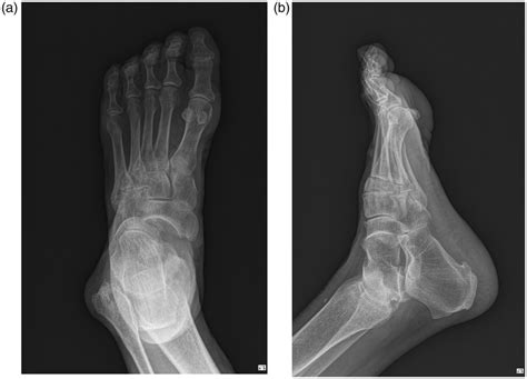 Plain A Anteroposterior And B Lateral Radiographs Of The Initial