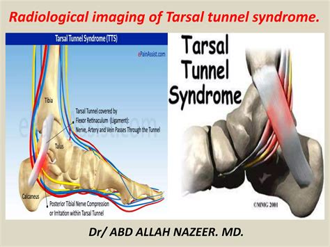 Presentation1 radiological imaging of tarsal tunnel syndrome. | PPTX