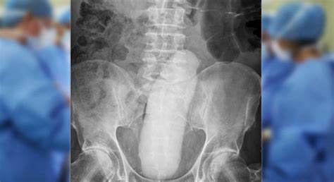 Va In Ospedale Con Forti Dolori Addominali Aveva Un Dildo Di Cm Nel Sedere Alghero Eco