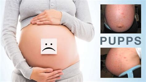 Pupps Rash In Pregnancy—natural Treatments Mama Natural