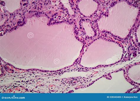 Histopathology Of Endemic Goitre Stock Image Image Of Light Detail