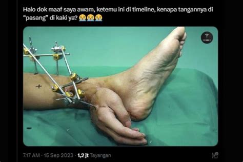 Foto Ramai Soal Foto Tangan Disambung Ke Kaki Ketika Operasi Ini