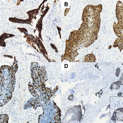 Immunohistochemistry Staining Of Tumor Cells That Were Positive For Ck