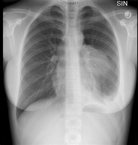 Lung Fissures X Ray