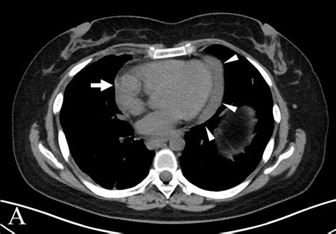 Mediastinal Diffuse Large B Cell Lymphoma Mimicking Invasive Thymoma On