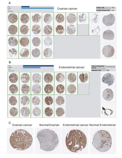 Klhl14 An Ovarian And Endometrial Specific Gene Is Over Expressed In Ovarian And Endometrial