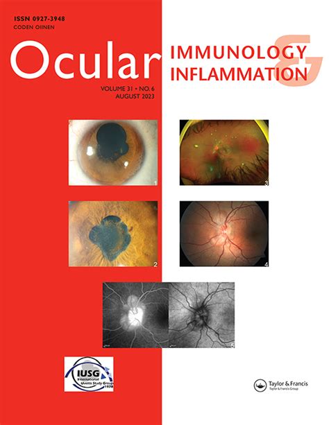 Optic Neuritis Following The Bnt B Mrna Covid Vaccine In A