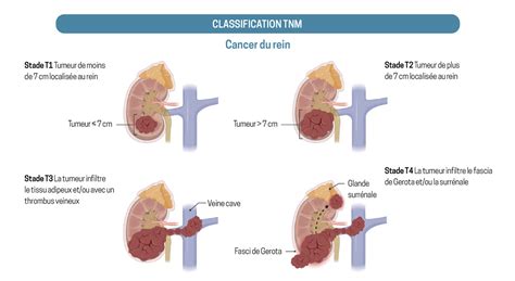 Les Stades De La Classification Tnm Du Cancer Du Rein La Revue Du