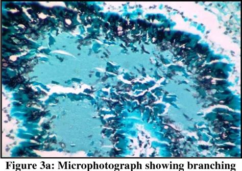 Figure From Eumycetoma On Histopathology Presenting At Unusual Site