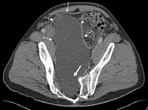 Computed Tomography Scan Axial View Of The Anterior Sacral Meningocele