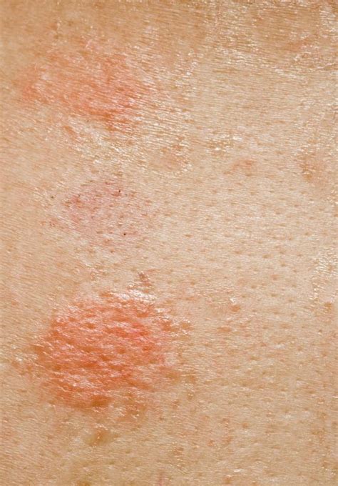 What Are the Most Common Causes of Circular Rashes?