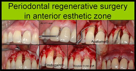 Dental Implant Professional Periodontal Regenerative Surgery In