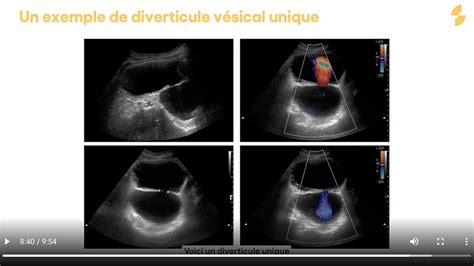 Pathologies de la vessie Échographie vésicale Sonoschool