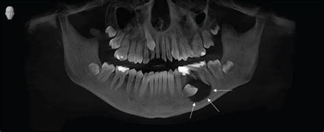 A Opg X Ray Unilocular Radiolucency Surrounding The Crown Of The