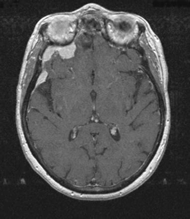 Radiation Associated Meningioma In The Elderly Development Of