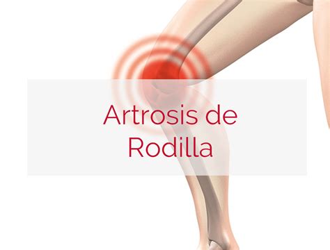 Artrosis de Rodilla Síntomas Causas y Tratamientos Orthokine