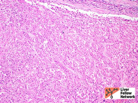 Pathology Pearls Hepatocellular Carcinoma Aasld