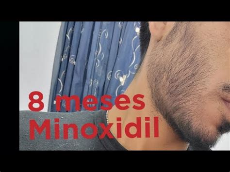 Minoxidil Para Barba Y Cabello Octavo Mes Crecimiento De Barba Primer